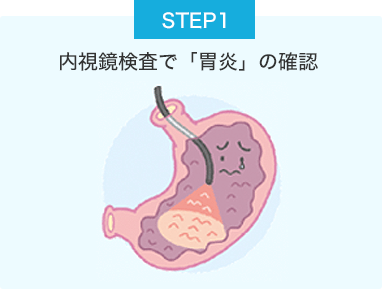 STEP1 内視鏡検査で「胃炎」の確認