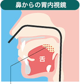 鼻からの胃内視鏡