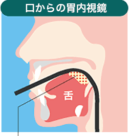 口からの胃内視鏡